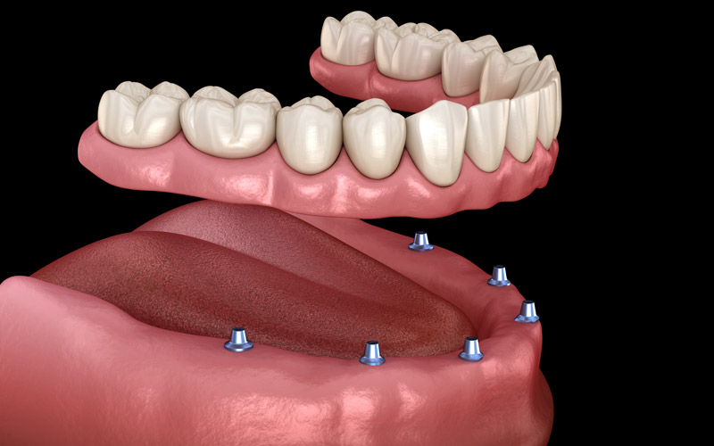 Informaţii detaliate despre protezele dentare fixe pe implanturi