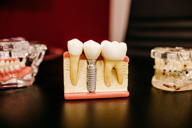 Ce implant dentar sa alegi? Iata cateva criterii de luat in calcul!